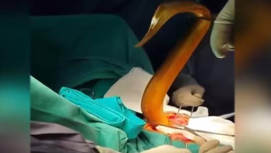 Indian man puts live 2-foot eel up his anus, it chews through his intestines