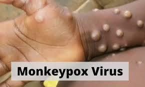 Monkeypox scare: AIIMS Delhi issues guidelines to treat suspected patients.